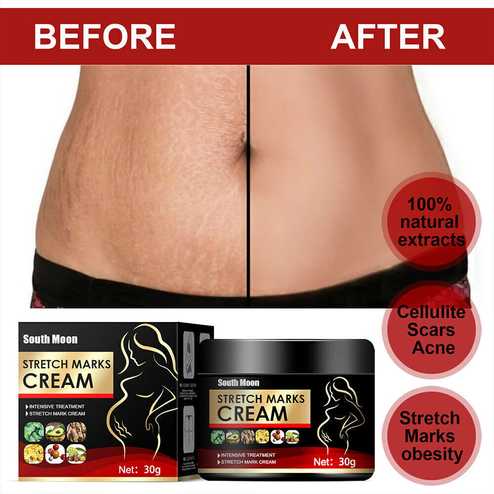 UK Pregnancy Scar, Spots Acne Scar, Stretch Marks Removal Cream Clarifying Skin